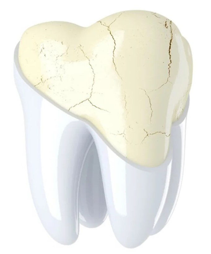 Трещины на эмали зуба