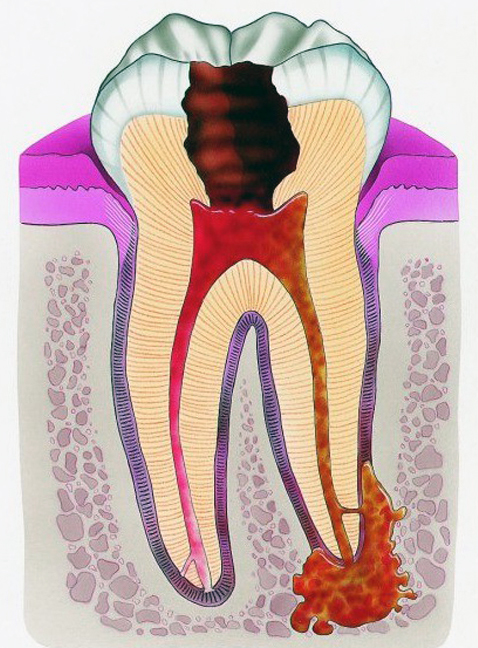 Зуб, больной периодонтитом