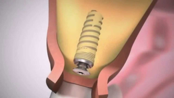 implantacia_video.jpg