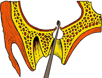 Перфорация верхнечелюстной пазухи