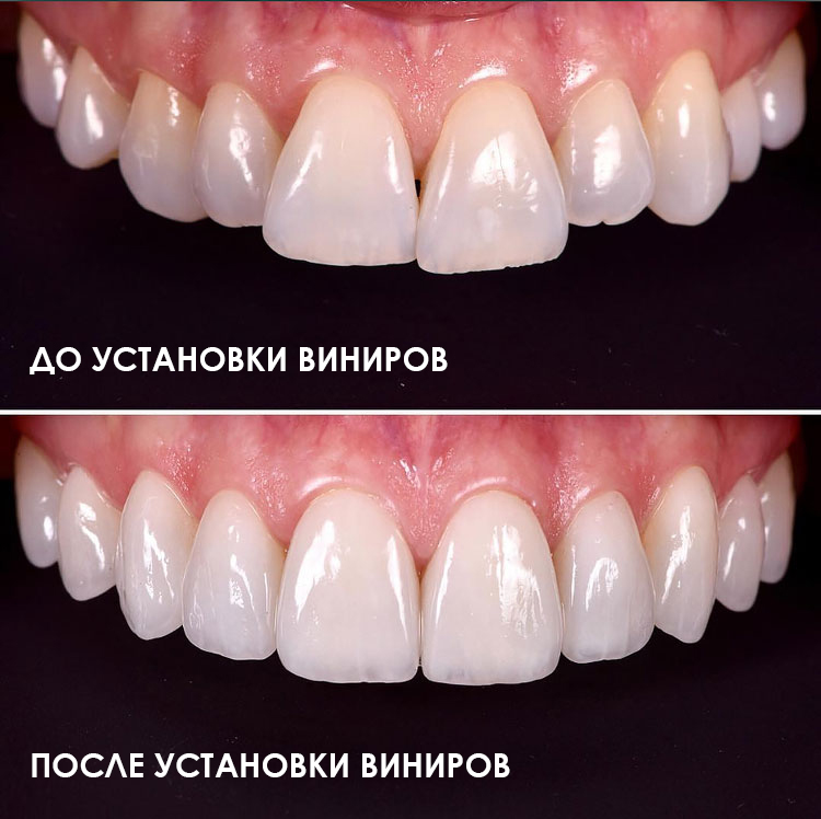 Зубы до и после установки виниров