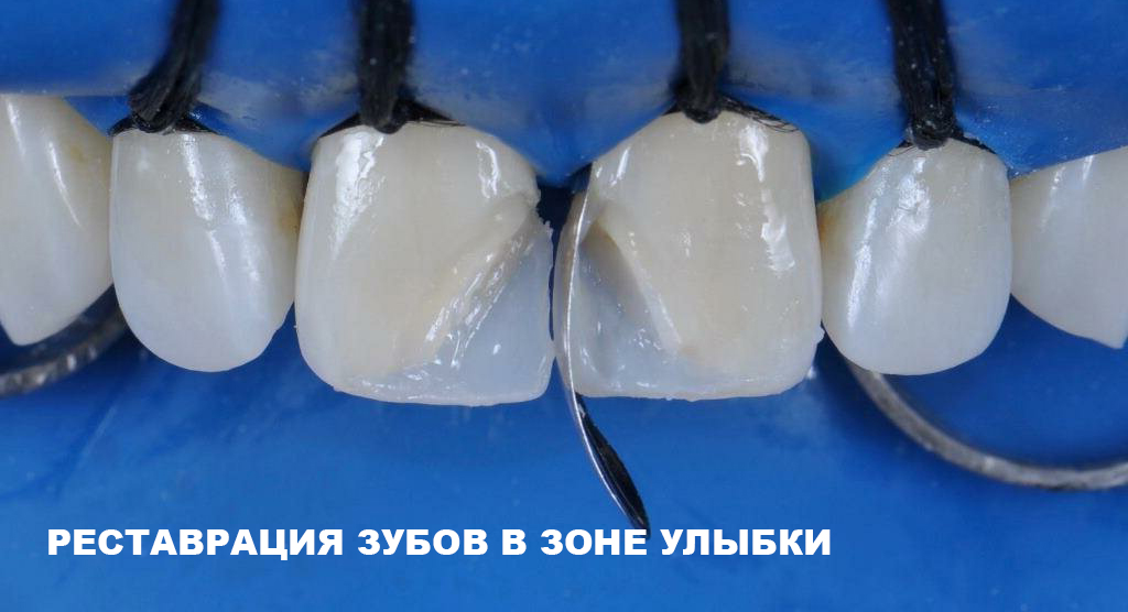 Реставрация зубов в зоне улыбки