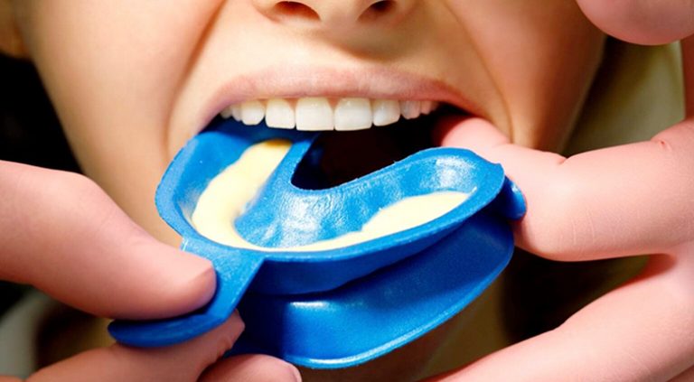 Лечение гиперестезии зубов