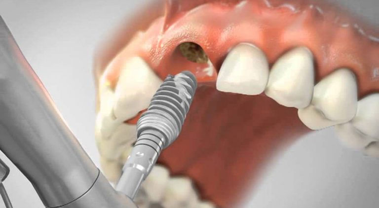 Возможна установка импланта в одно и то же место после отторжения