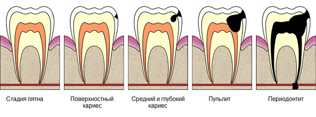 Стадии кариеса картинки