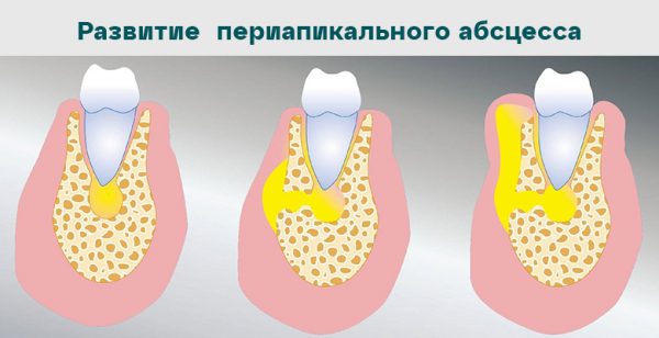 Развитие периапикального абсцесса