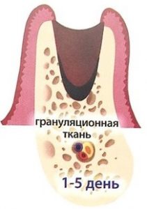 Второй этап восстановления десны после удаления зуба