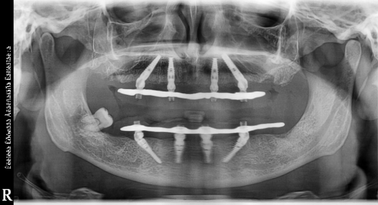 Несъемное протезирование TiS на 2 челюстях